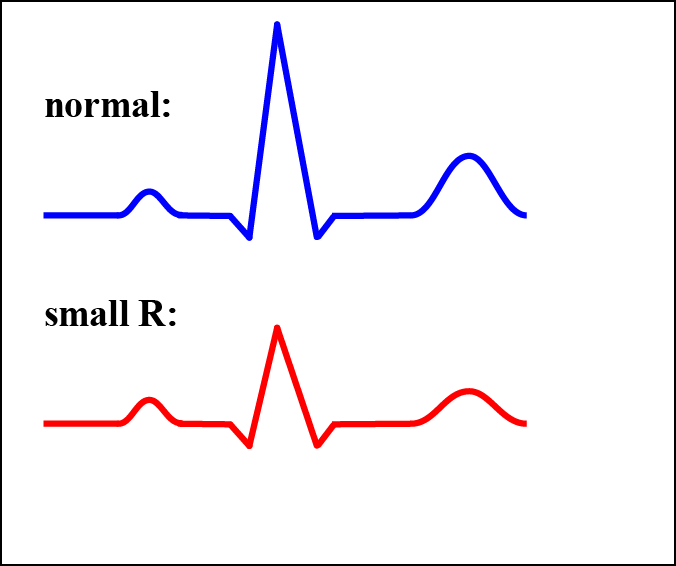 small R in the ECG
